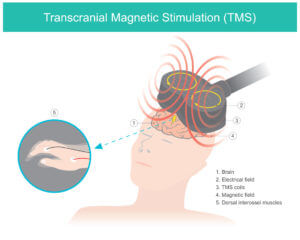 Transcranial Magnetic Stimulation (TMS) illustration